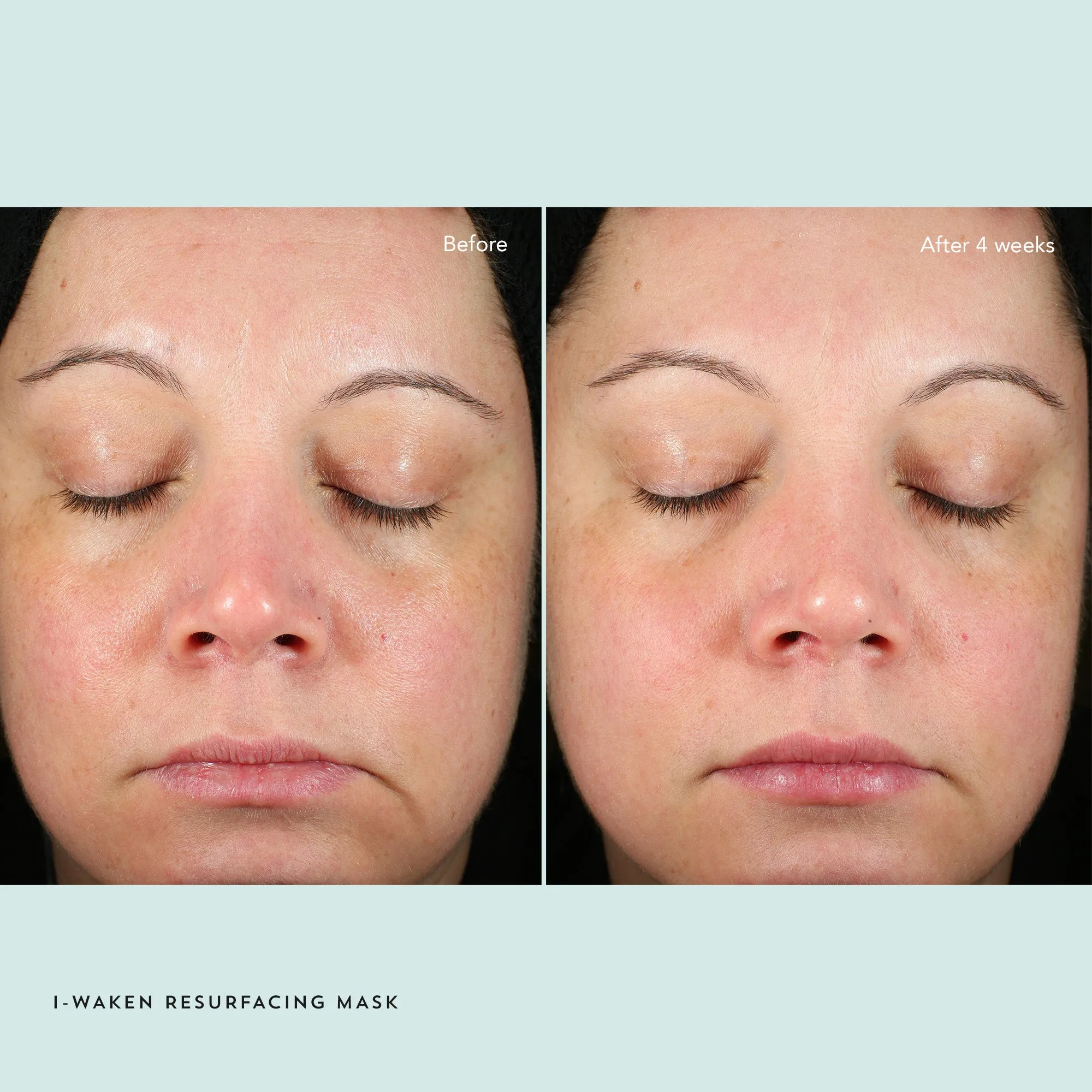 I-Waken Resurfacing Mask